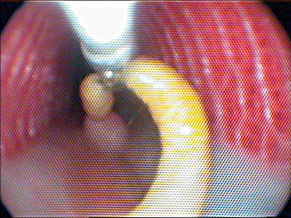 Pentastomid Parasite