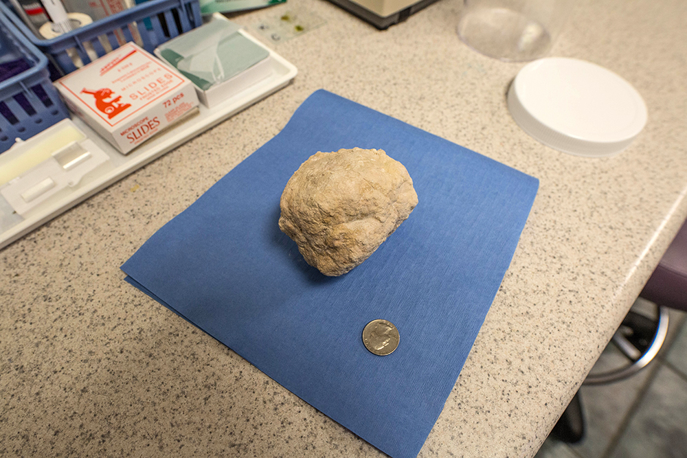 bladder stone in a sulcata